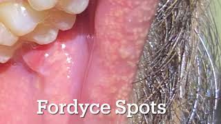 Fordyce Spots white yellow bumps over lips and cheek Should I worry [upl. by Anirual524]