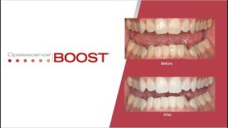 StepbyStep Opalescence Boost Teeth Whitening Procedure  Australia [upl. by Clim]