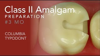 Class II Amalgam Preparation 3 MO [upl. by Sandie404]