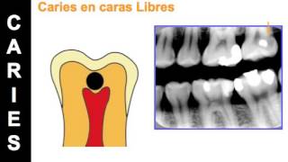 Aspectos Radiograficos de la Caries Dental [upl. by Olimac381]