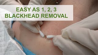 Easy as 1 2 3 Blackhead Removal  Dr Derm [upl. by Farmelo]